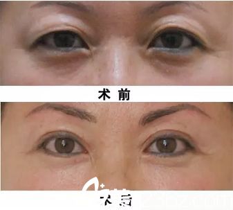 雙眼皮手術(shù)緊致眼部皮膚