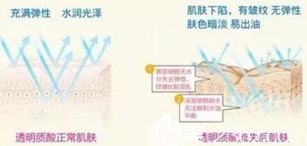 面部抗衰老應(yīng)由無(wú)創(chuàng)到微創(chuàng)再到手術(shù) 面部抗衰老應(yīng)由無(wú)創(chuàng)到微創(chuàng)再到手術(shù)