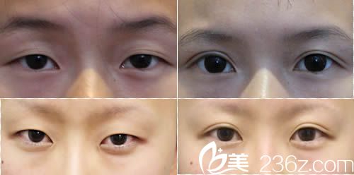 包頭麗人雙眼皮案例圖