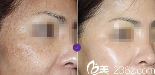 麗人激光祛斑前后對比效果