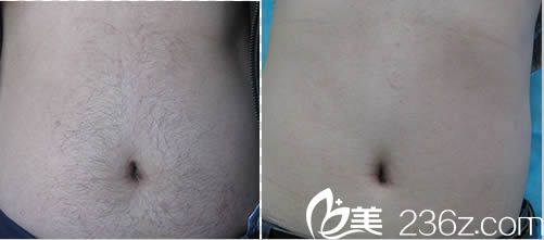 激光無痕脫毛真人案例圖