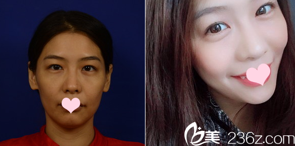 深圳米蘭柏羽陳玉面部線雕提升案例