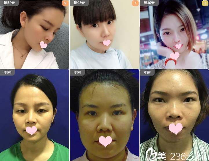 深圳米蘭柏羽劉俊醫(yī)生隆鼻案例組圖 深圳米蘭柏羽劉俊醫(yī)生隆鼻案例組圖