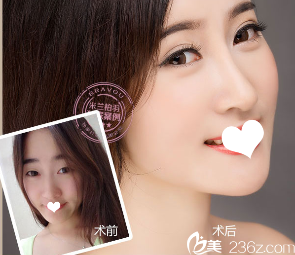 深圳米蘭柏羽盧尚兵主任美杜莎雙眼皮案例