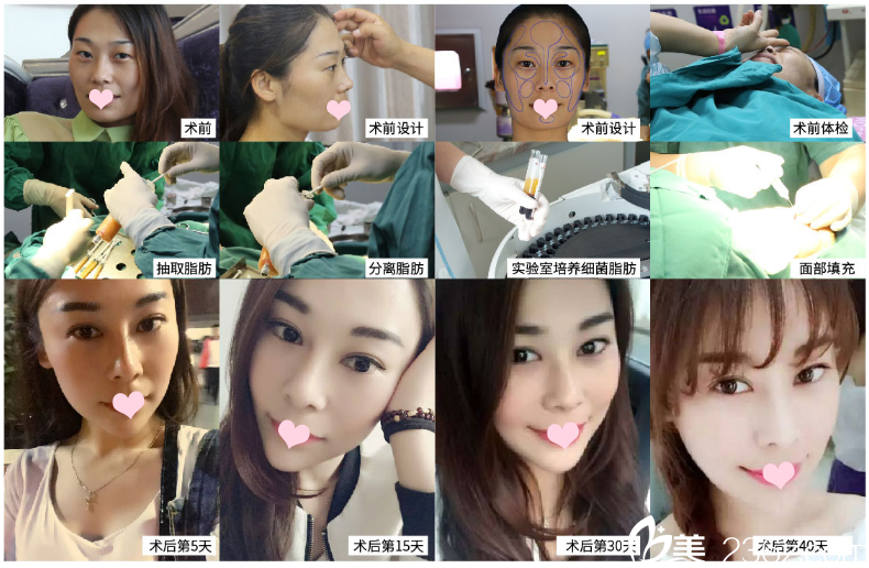 廣州廣美整形美容醫(yī)院案例展示 廣州廣美整形美容醫(yī)院案例展示