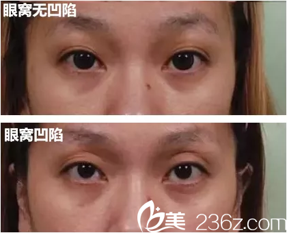 眼窩凹陷與不凹陷的區(qū)別