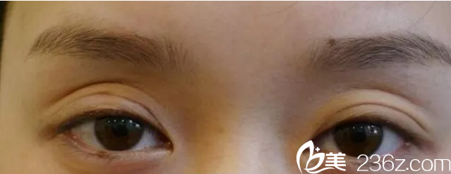 雙眼皮手術(shù)導(dǎo)致的眼窩凹陷