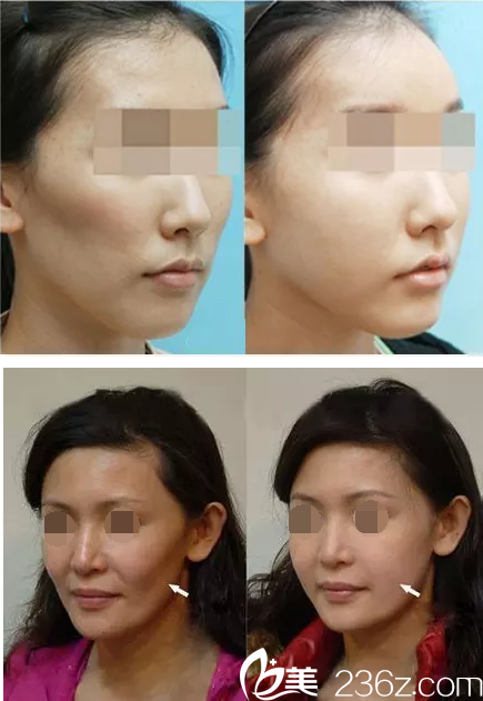 臉頰凹陷與填充效果