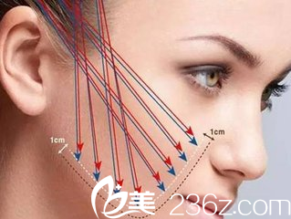 線雕是整形行業(yè)中的新型技術被推崇