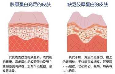 皮膚膠原蛋白充足與缺失的狀況對比