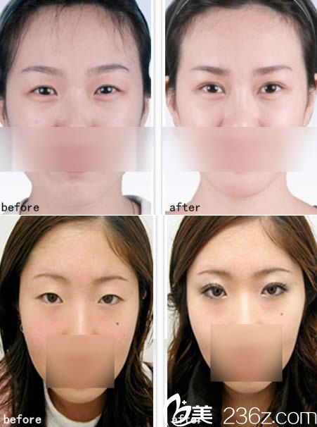 呼市大韓切開雙眼皮案例效果圖