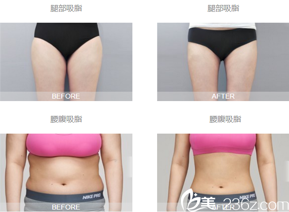 潘紅偉吸脂案例對(duì)比圖 潘紅偉吸脂案例對(duì)比圖