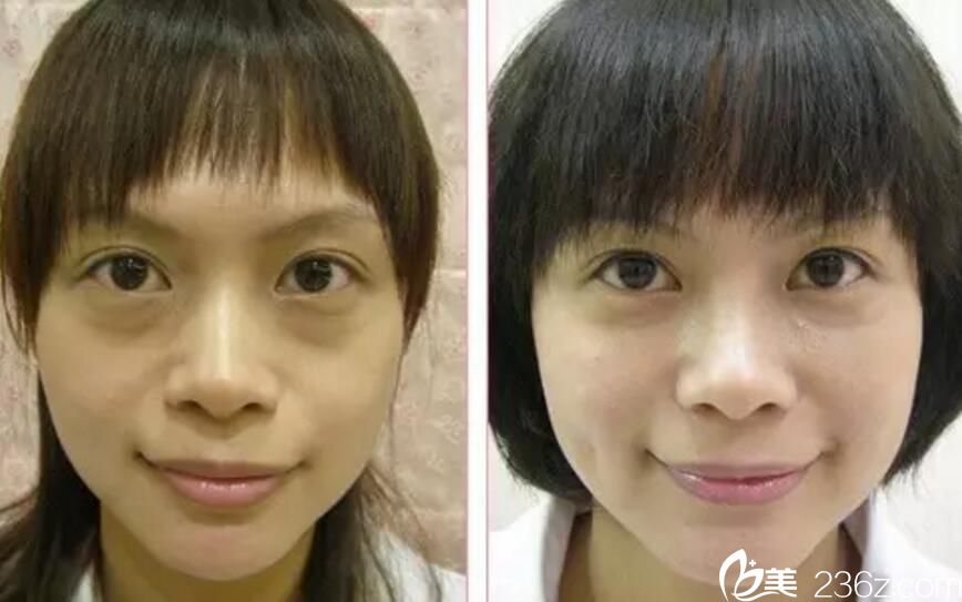 吳彩霞經(jīng)典注射案例 吳彩霞經(jīng)典注射案例