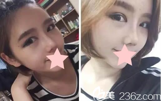 綜合隆鼻術(shù)后20天的恢復(fù)效果 綜合隆鼻術(shù)后20天的恢復(fù)效果