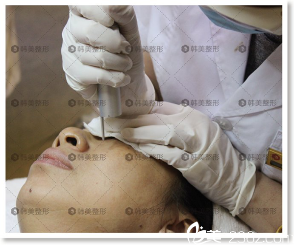 激光去痣 吳彩霞主任正在細心操作 激光去痣 吳彩霞主任正在細心操作