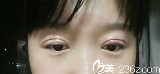 做納米無痕雙眼皮手術(shù)失敗