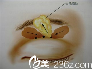 納米無痕雙眼皮與埋線雙眼皮的手術(shù)原理一樣