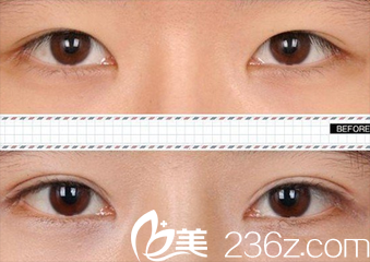 正規(guī)醫(yī)院做的切開雙眼皮前后對比案例