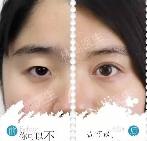 林潮三點(diǎn)微創(chuàng)雙眼皮案例效果 林潮三點(diǎn)微創(chuàng)雙眼皮案例效果