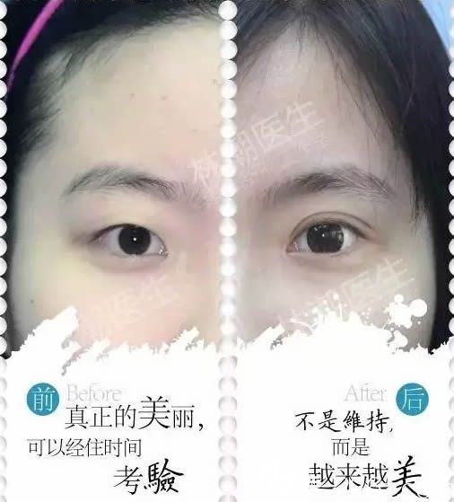 福州林潮割雙眼皮前后對(duì)比案例圖 福州林潮割雙眼皮前后對(duì)比案例圖