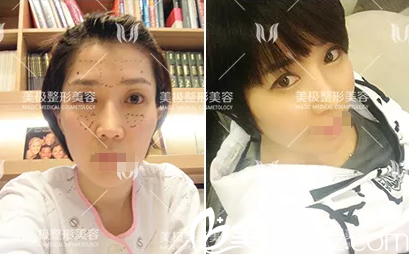 成都美極面部年輕化案例