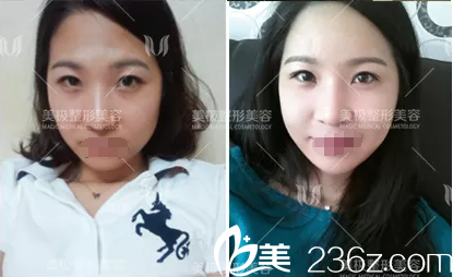 石曉軍玻尿酸填充面部+線雕提升案例