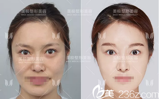 石曉軍面部填充+V臉注射案例