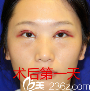 割完雙眼皮天恢復(fù)情況