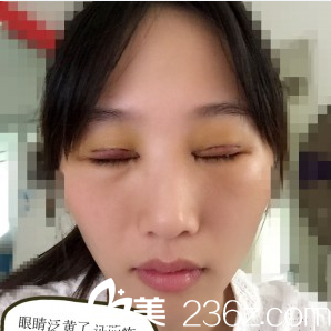 在深圳米蘭柏羽做完雙眼皮第二天閉眼效果