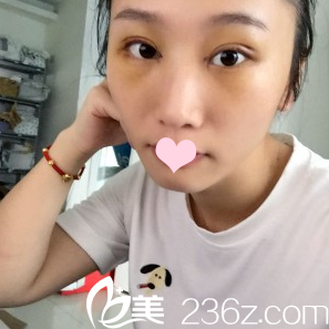 看深圳米蘭柏羽朱武根主任為我做的美杜莎雙眼皮案例效果怎么樣