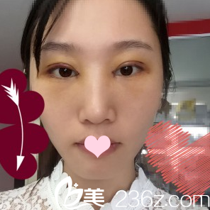 雙眼皮術(shù)后3天正面自拍