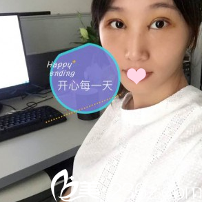 雙眼皮第三天工作照