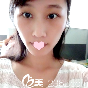 找朱武根主任做雙眼皮第7天