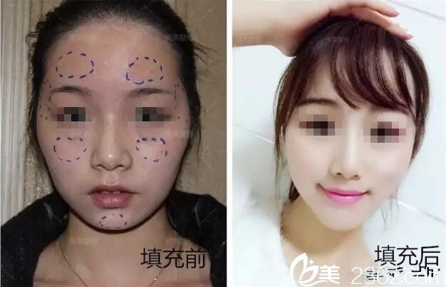 面部脂肪填充前后對比照片 面部脂肪填充前后對比照片
