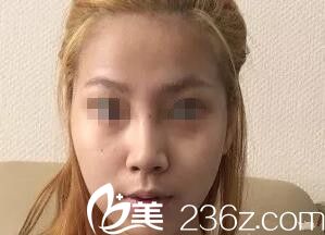 術前樣貌 術前樣貌