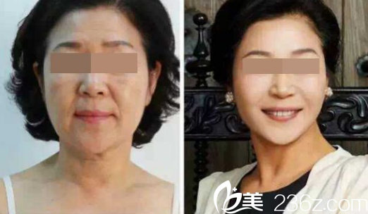 西安美萊醫(yī)學美容醫(yī)院真人案例