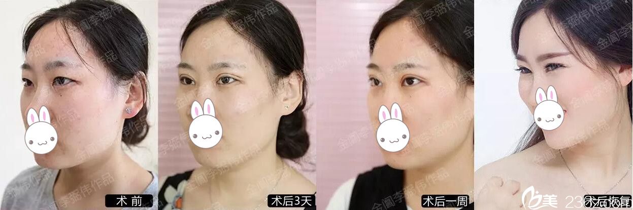 蘇州金閶醫(yī)院雙眼皮整形哪個(gè)醫(yī)生好?推薦李弼偉案例效果好