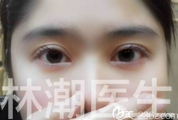 記錄福州林潮醫(yī)生割雙眼皮+開(kāi)眼角案例及一年后恢復(fù)效果圖