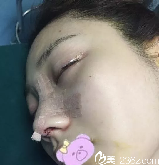 鼻綜合當(dāng)天