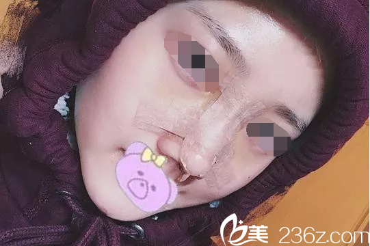 鼻綜合手術(shù)后第3天