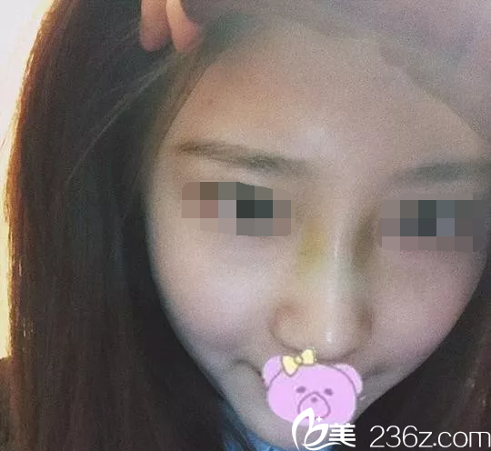 韓國(guó)will醫(yī)院鼻綜合手術(shù)后第7天