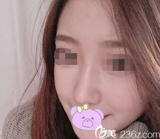 隆鼻后鼻子恢復(fù)效果