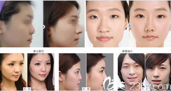 綜合隆鼻案例_<!--<i data=20240703-sp></i>-->明 綜合隆鼻案例_<!--<i data=20240703-sp></i>-->明