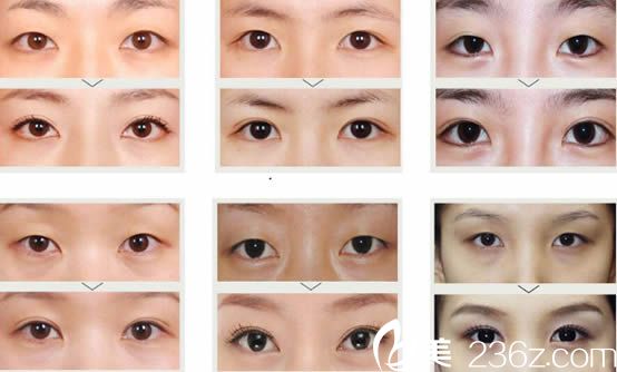 YC媚眼術(shù)雙眼皮案例_<!--<i data=20240703-sp></i>-->明院長 YC媚眼術(shù)雙眼皮案例_<!--<i data=20240703-sp></i>-->明院長