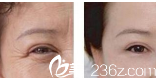 北京煤醫(yī)整形眼部除皺<span style= 北京煤醫(yī)整形眼部除皺<span style=