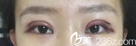 剛做完全切雙眼皮即刻的照片