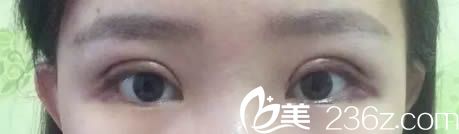 切開(kāi)雙眼皮術(shù)后第3天恢復(fù)效果