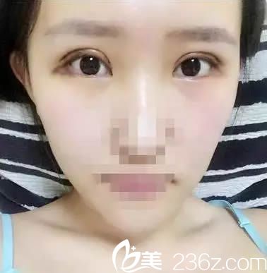 全切雙眼皮7天拆線后的美照