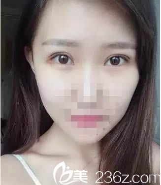 講述找福州新世紀(jì)整形醫(yī)院明做全切雙眼皮15天恢復(fù)過程