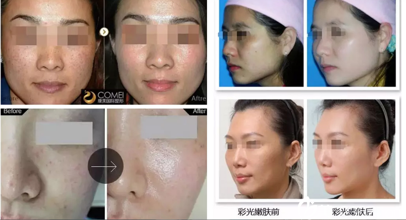 秦琴醫(yī)生整形案例 秦琴醫(yī)生整形案例